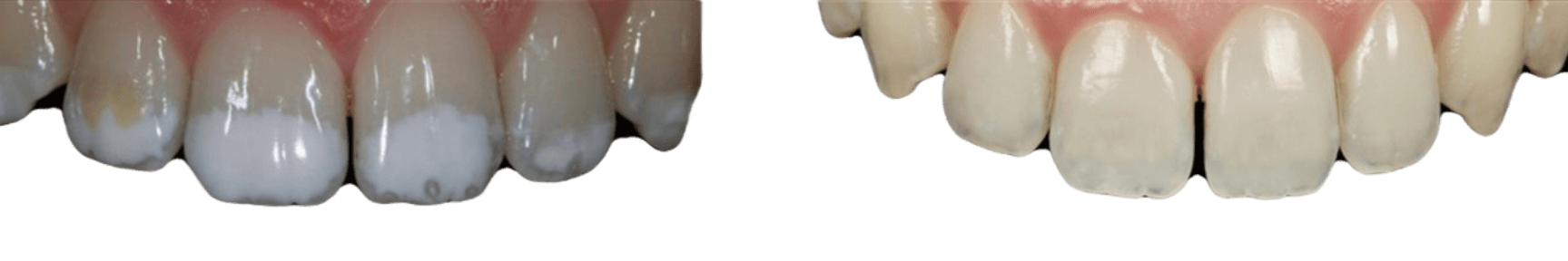 Before and after resin infiltration dental result