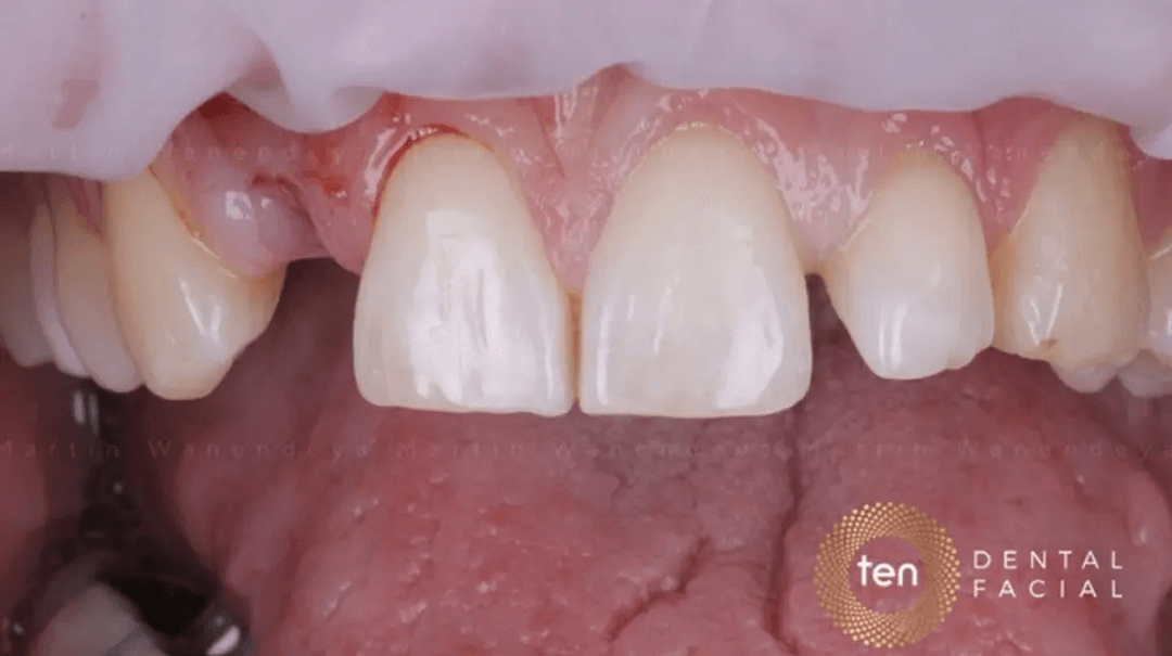 Certificate in Foundation in Implant Restorative Essentials (EduQual Level 7)