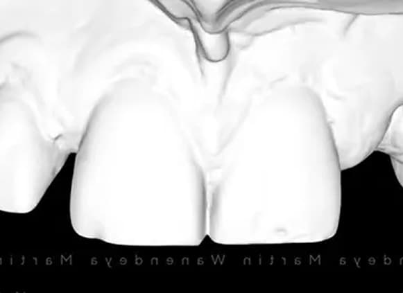 Implant restorative model