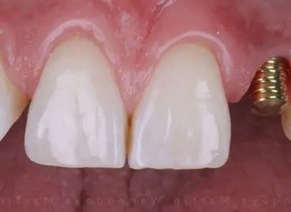 Completed implant restoration