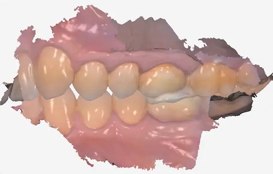 Occlusion