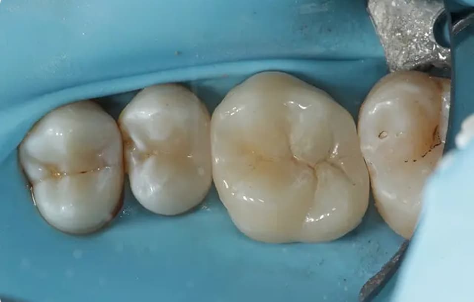 Isolation and cementation