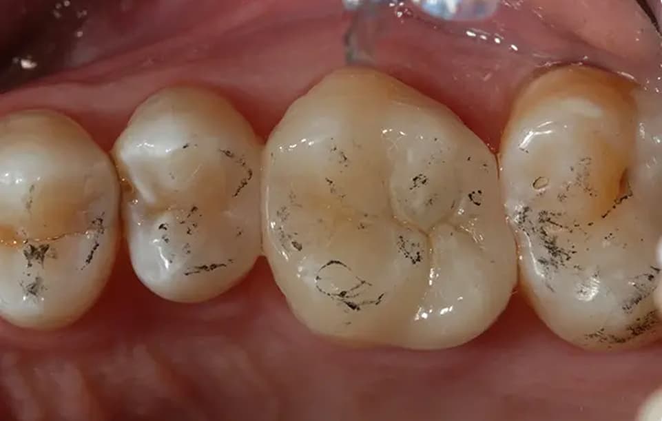 Post cementation adjustments